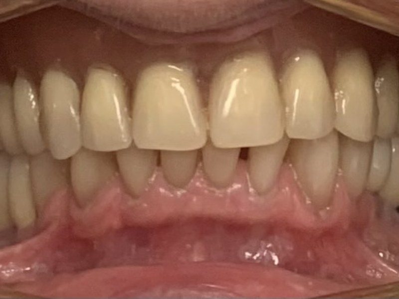 Przed leczeniem